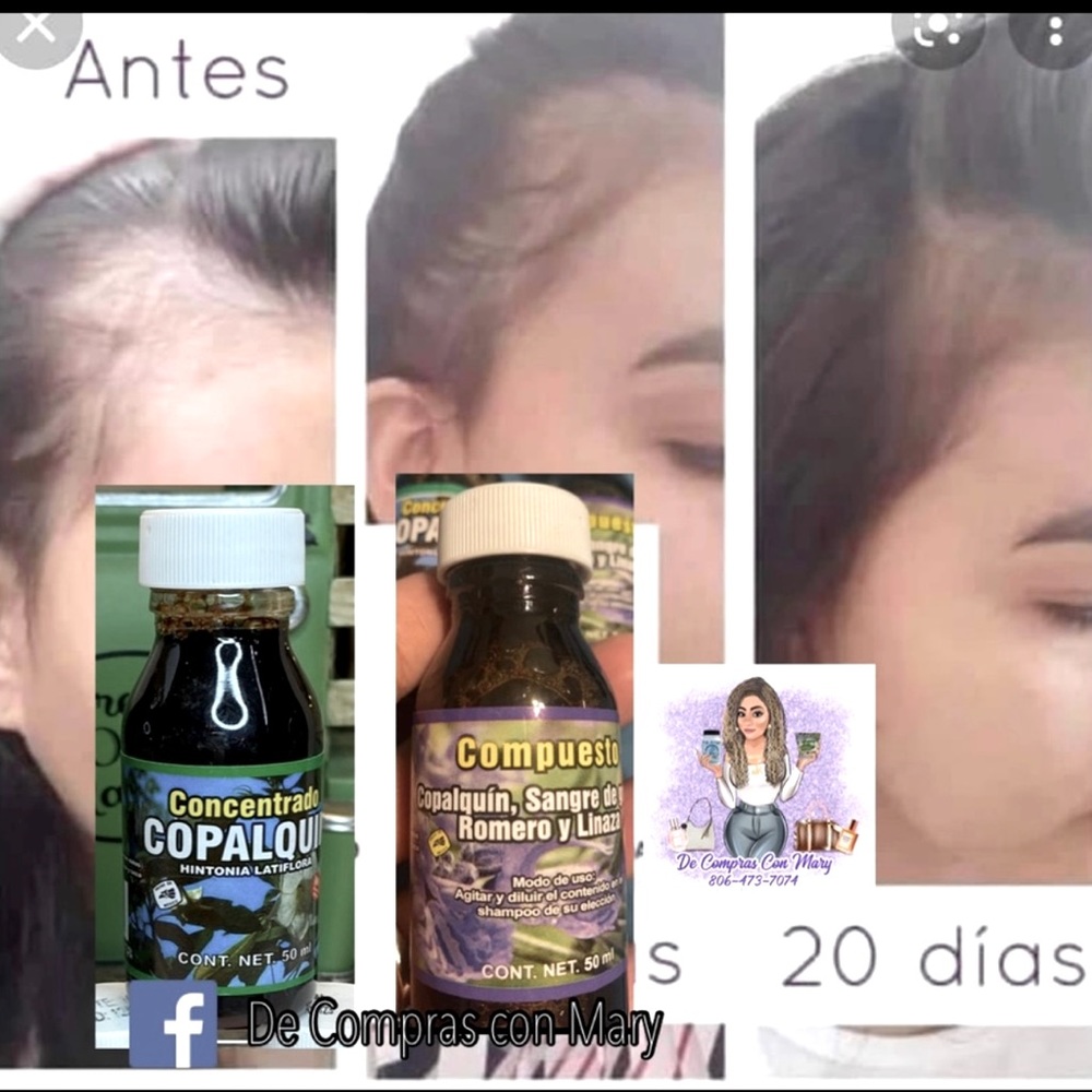 Hair Loss Regrowth Treatment 100% made from
herbs!!
Product from Mexico